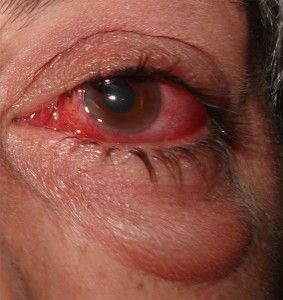 conjuntivitis2