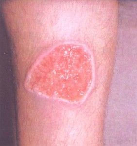 Lehismaniasis
