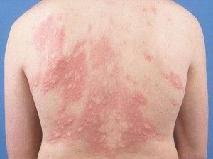 urticaria a frigore