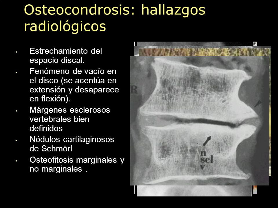osteocondroza c4