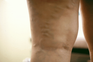 edema varices