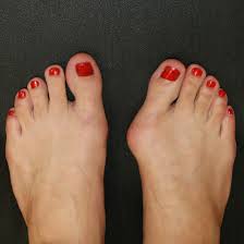 hallus valgus