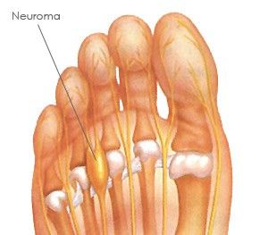 neuroma