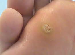 papiloma